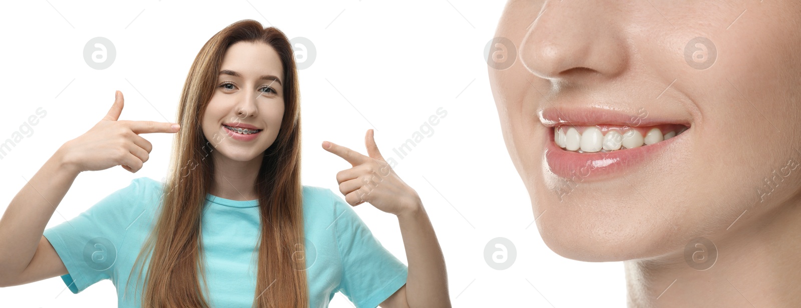 Image of Dental braces for straightening teeth. Collage with photos of smiling woman on white background, before and after