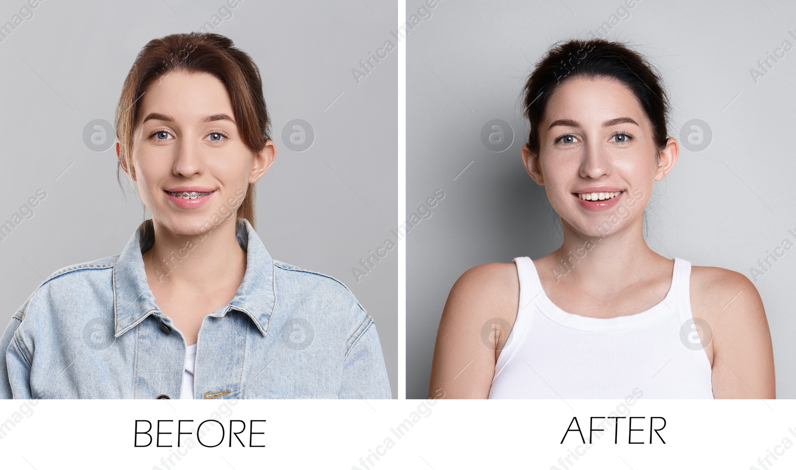 Image of Collage with photos of woman with dental braces and perfect teeth on grey background. Before and after
