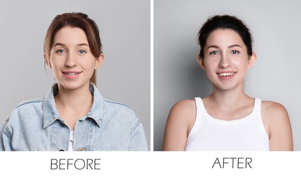 Image of Collage with photos of woman with dental braces and perfect teeth on grey background. Before and after