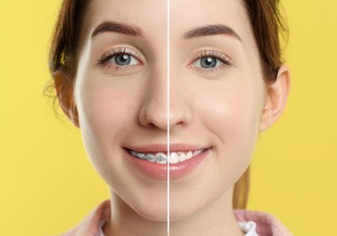 Image of Dental braces for straightening teeth. Collage with before and after photo of smiling woman on yellow background, closeup