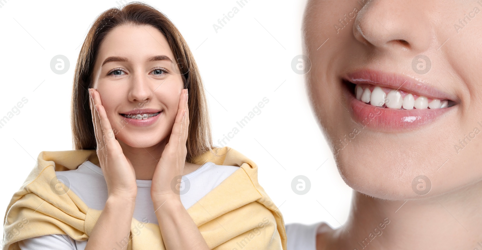 Image of Woman showing perfect teeth as result of using dental braces on white background, closeup. Collage with before and after photos