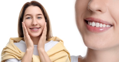 Image of Woman showing perfect teeth as result of using dental braces on white background, closeup. Collage with before and after photos