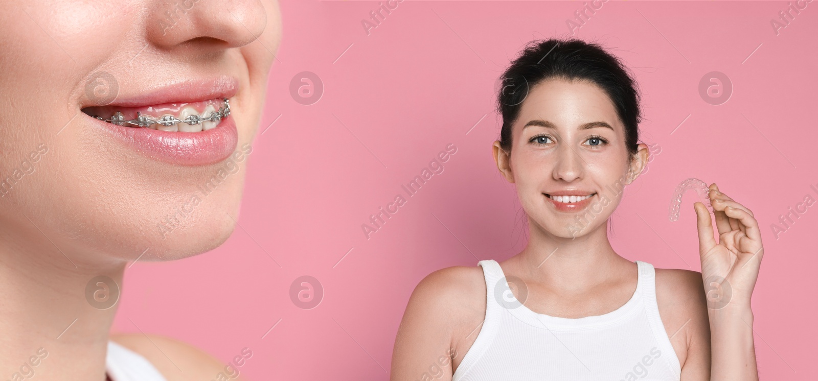 Image of Woman showing perfect teeth as result of using dental braces on pink background, closeup. Collage with before and after photos