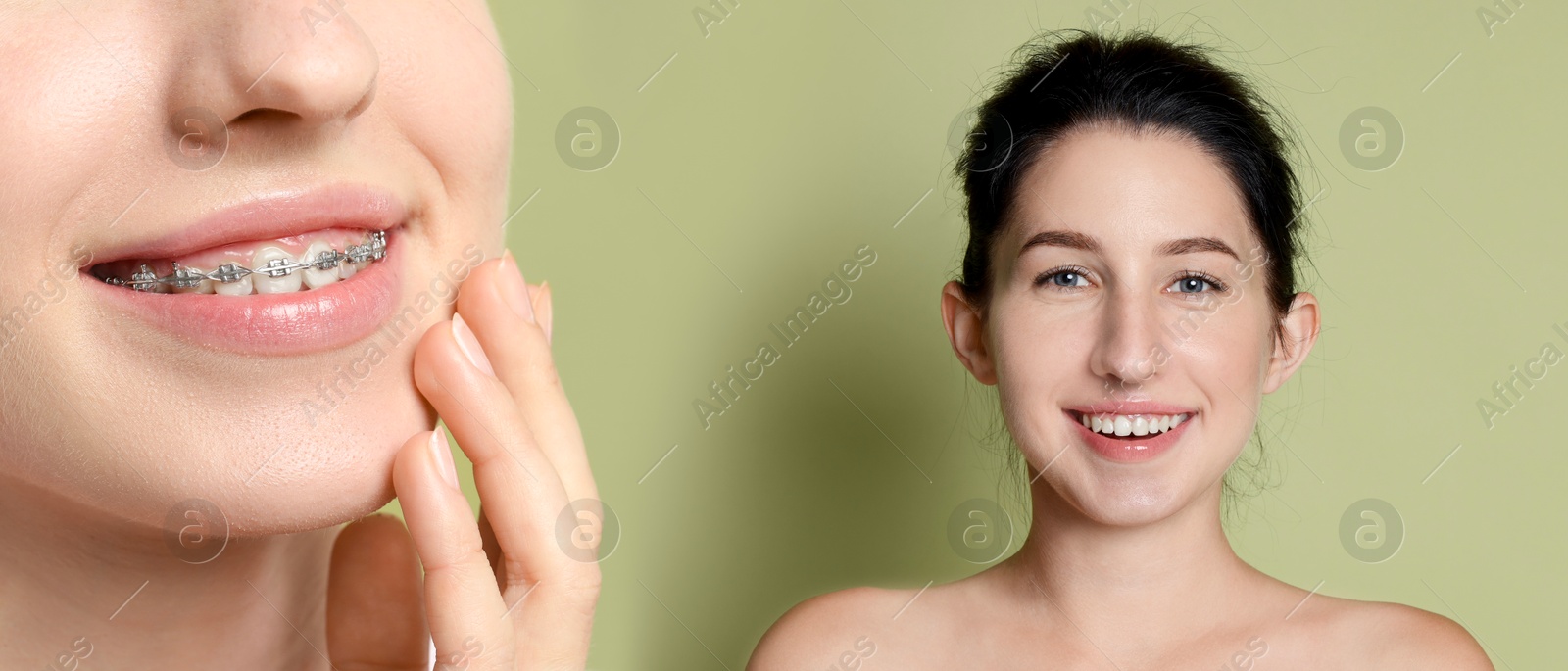 Image of Dental braces for straightening teeth. Collage with photos of smiling woman on light green background, before and after
