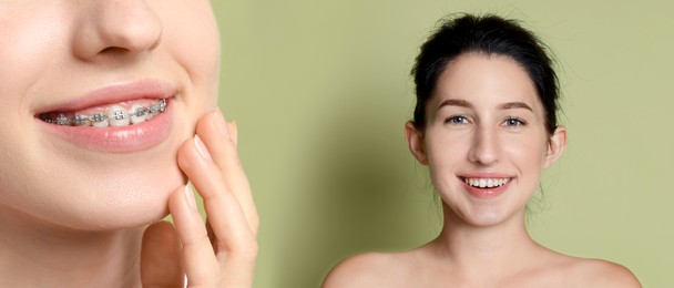 Image of Dental braces for straightening teeth. Collage with photos of smiling woman on light green background, before and after