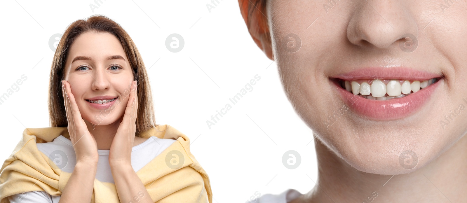 Image of Dental braces for straightening teeth. Collage with photos of smiling woman on white background, before and after