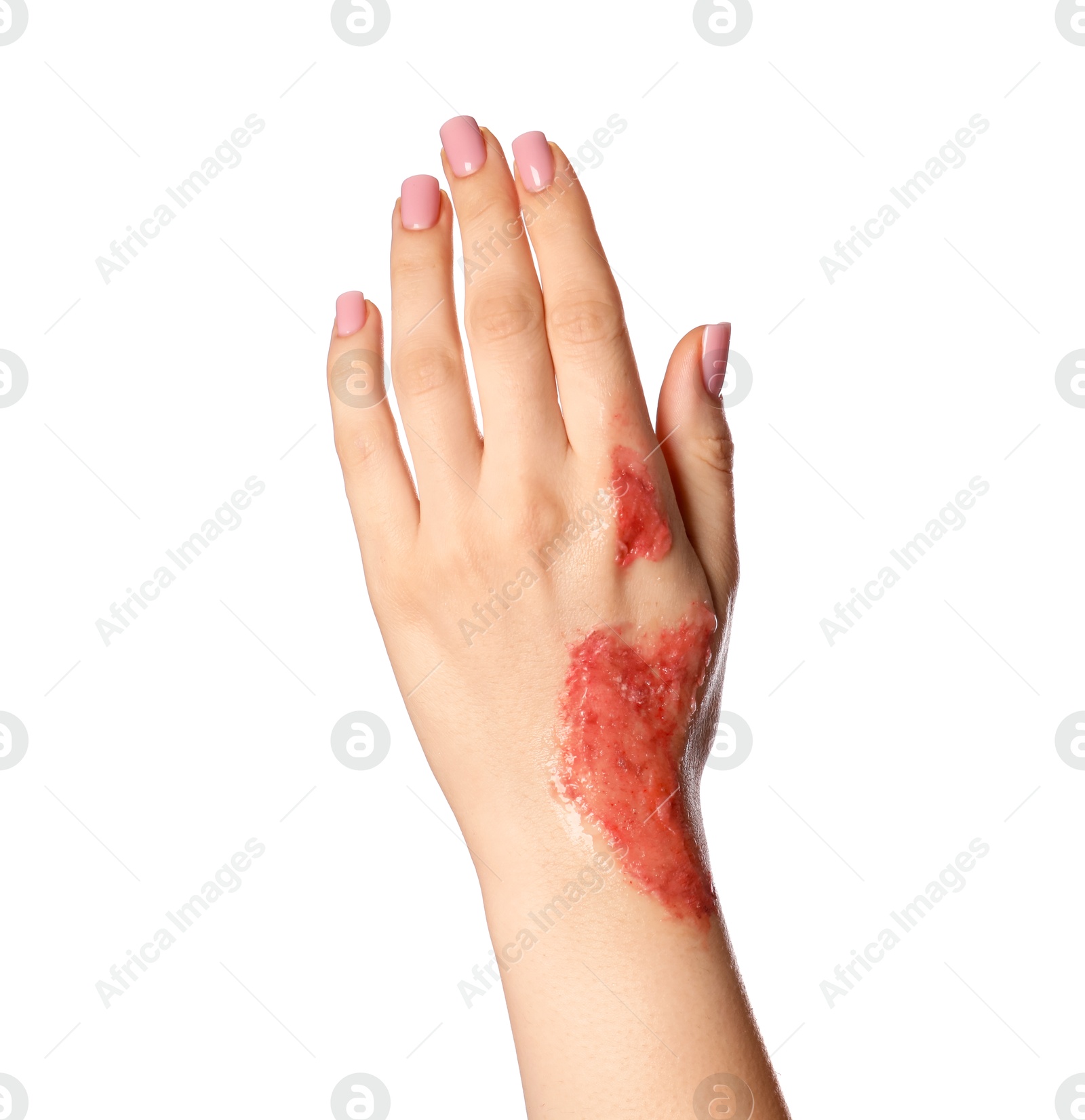 Photo of Woman with burned hand on white background, closeup