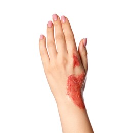 Photo of Woman with burned hand on white background, closeup