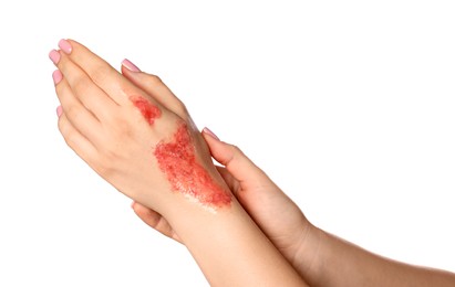 Photo of Woman with burned hand on white background, closeup