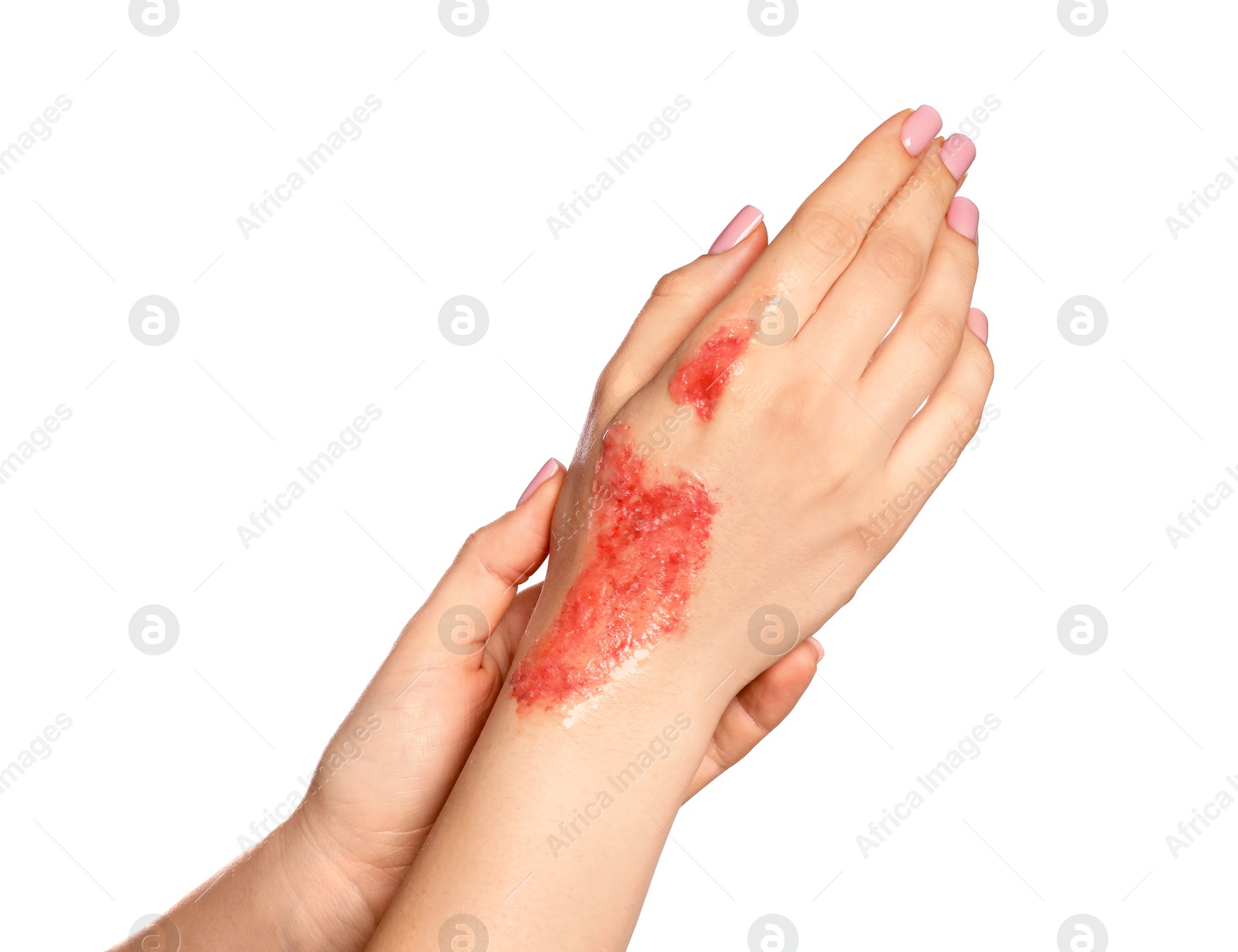 Photo of Woman with burned hand on white background, closeup