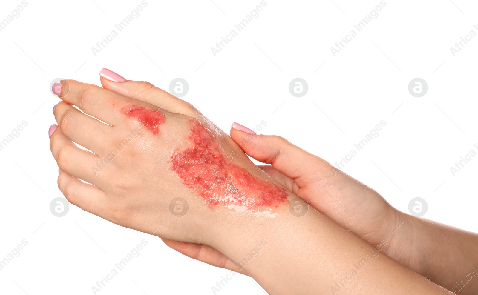 Photo of Woman with burned hand on white background, closeup