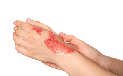 Photo of Woman with burned hand on white background, closeup