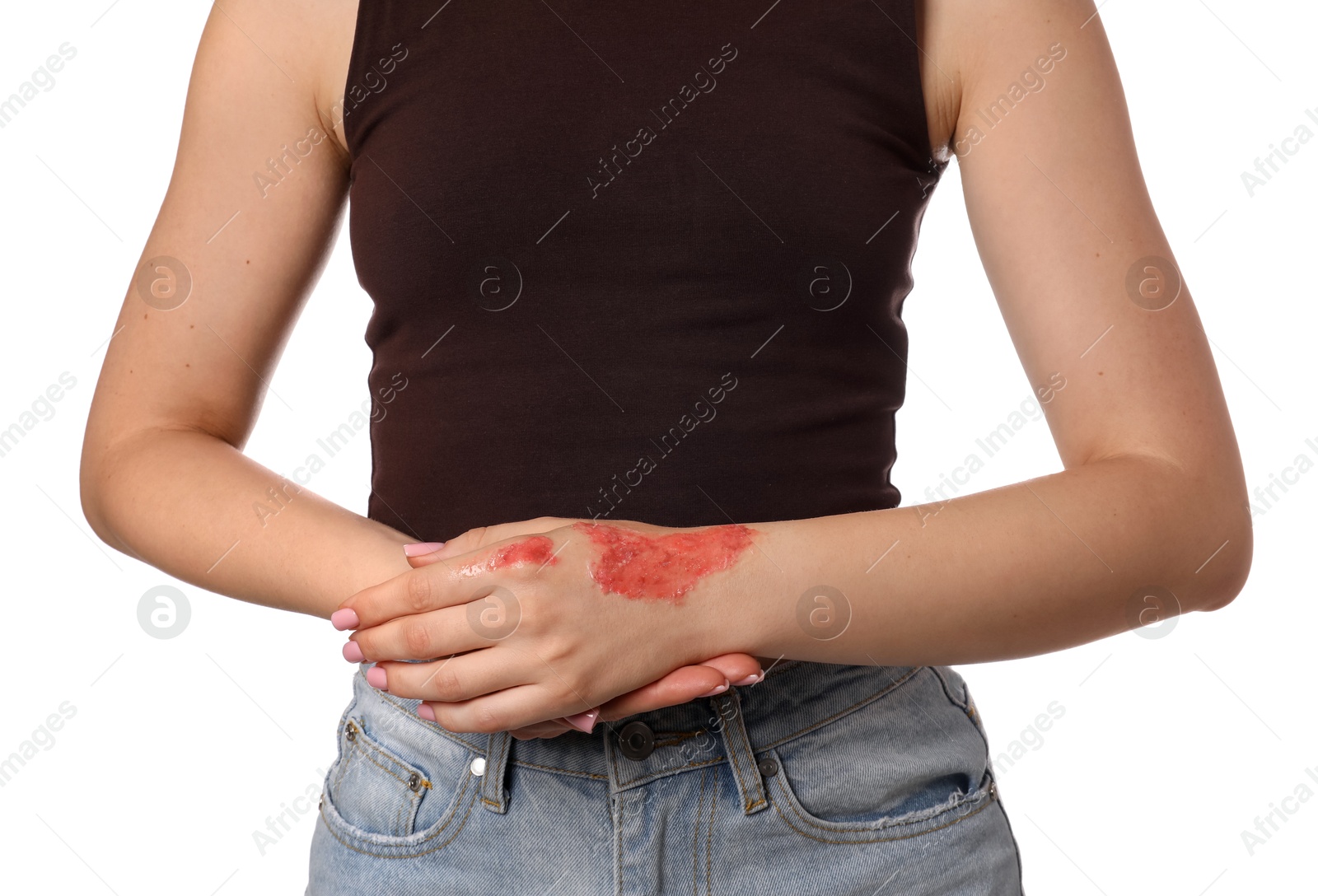 Woman with burned hand on white background, closeup Photo of Woman with burned hand on white background, closeup