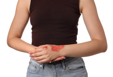 Photo of Woman with burned hand on white background, closeup