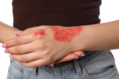 Photo of Woman with burned hand on white background, closeup