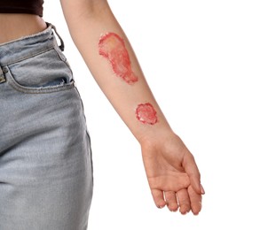 Photo of Woman with burned hand on white background, closeup