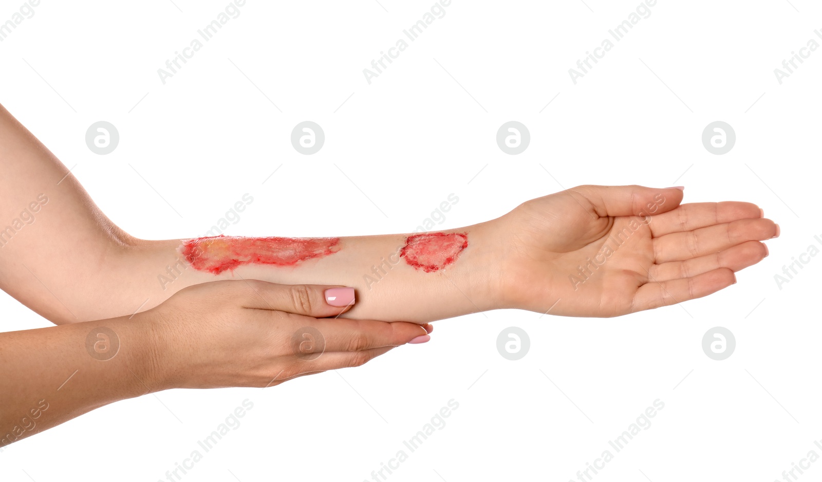 Woman with burned hand on white background, closeup Photo of Woman with burned hand on white background, closeup