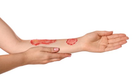 Photo of Woman with burned hand on white background, closeup