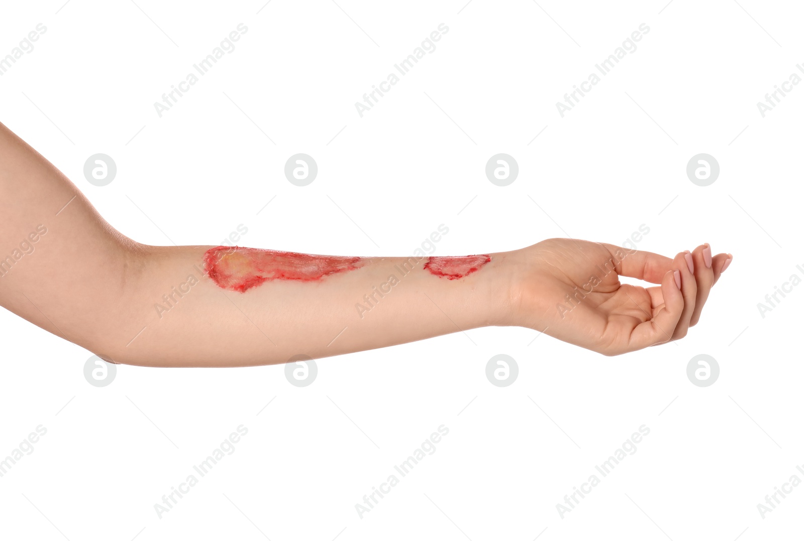 Photo of Woman with burned hand on white background, closeup