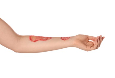Photo of Woman with burned hand on white background, closeup
