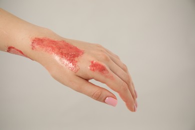 Photo of Woman with burned hand on light grey background, closeup. Space for text