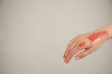 Photo of Woman with burned hand on light grey background, closeup. Space for text
