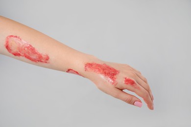 Photo of Woman with burned hand on light grey background, closeup. Space for text