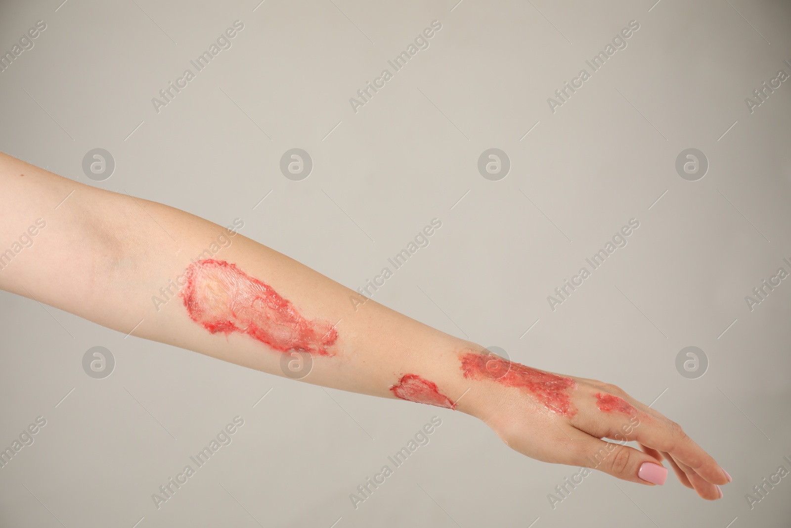 Photo of Woman with burned hand on light grey background, closeup. Space for text