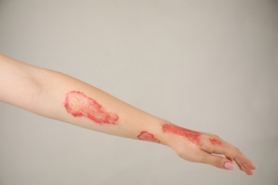 Photo of Woman with burned hand on light grey background, closeup. Space for text