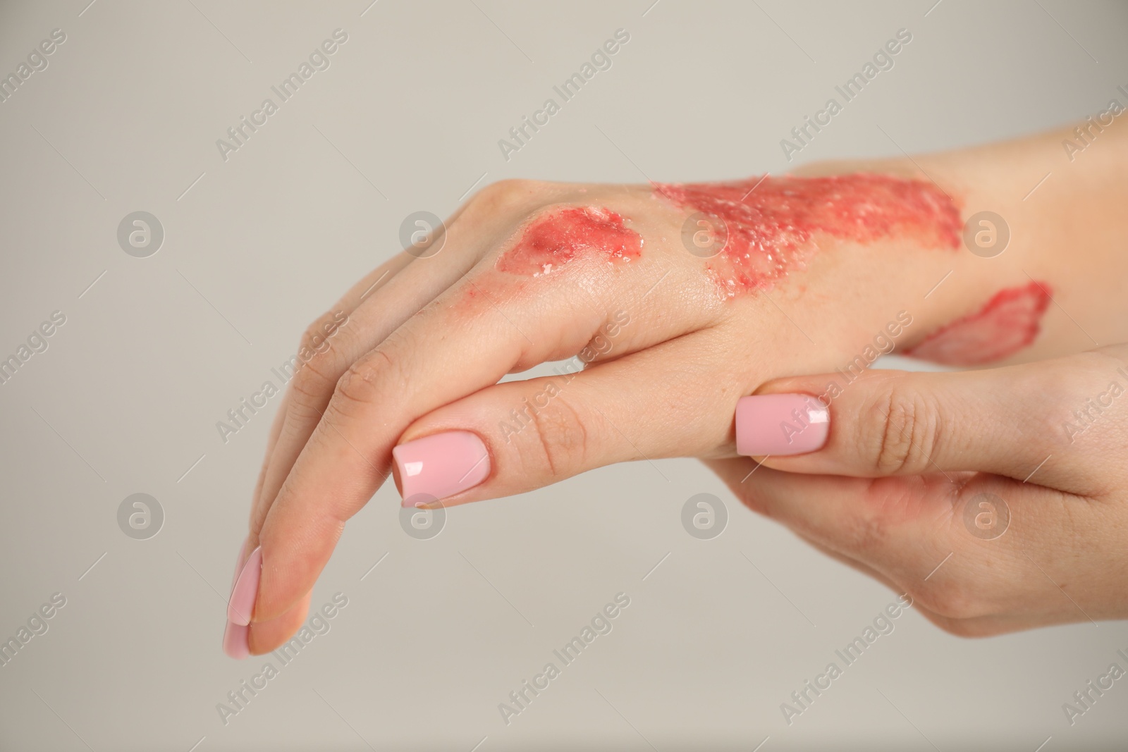 Photo of Woman with burned hand on light grey background, closeup