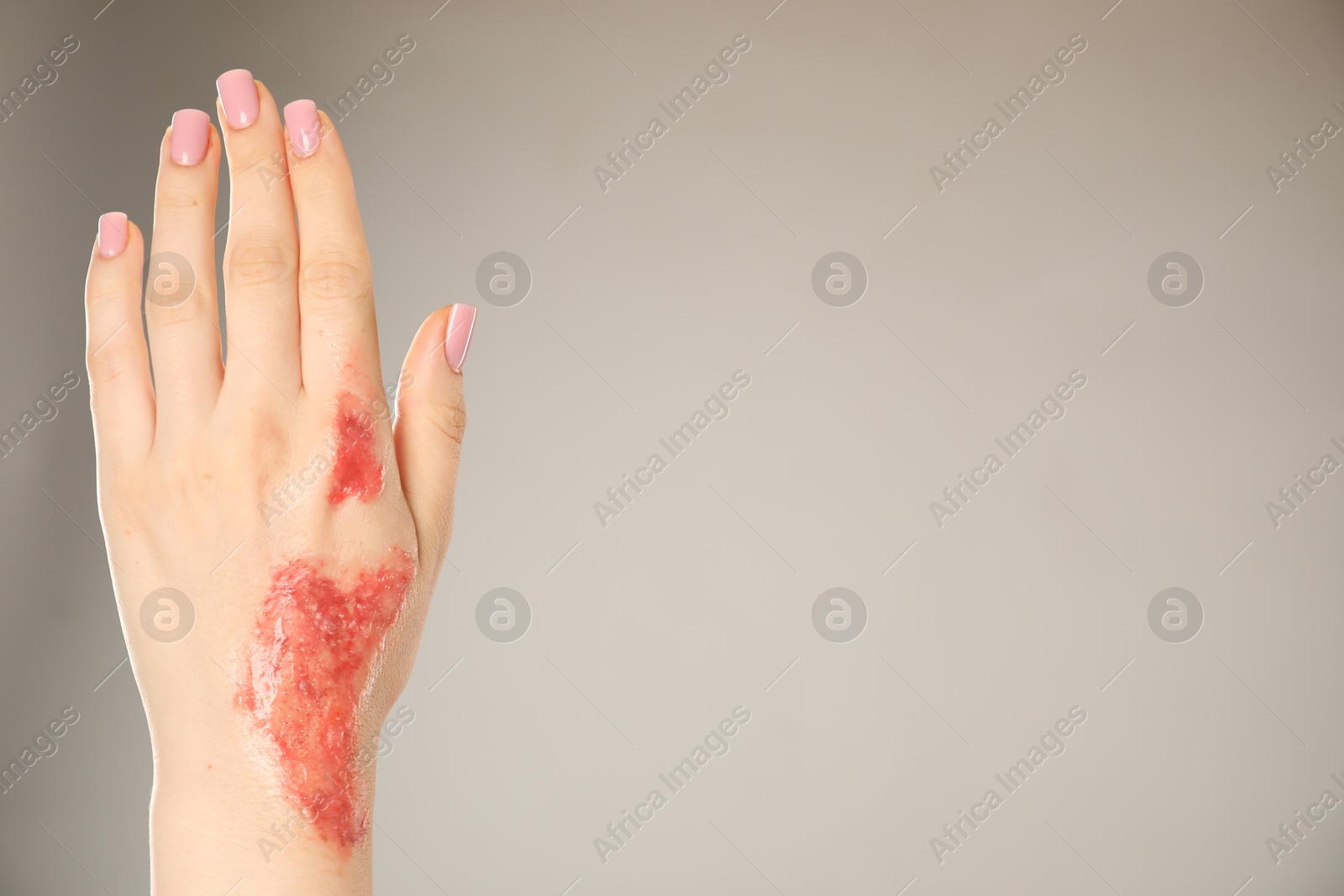 Woman with burned hand on light grey background, closeup. Space for text Photo of Woman with burned hand on light grey background, closeup. Space for text