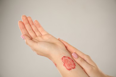 Photo of Woman with burned hand on light grey background, closeup. Space for text