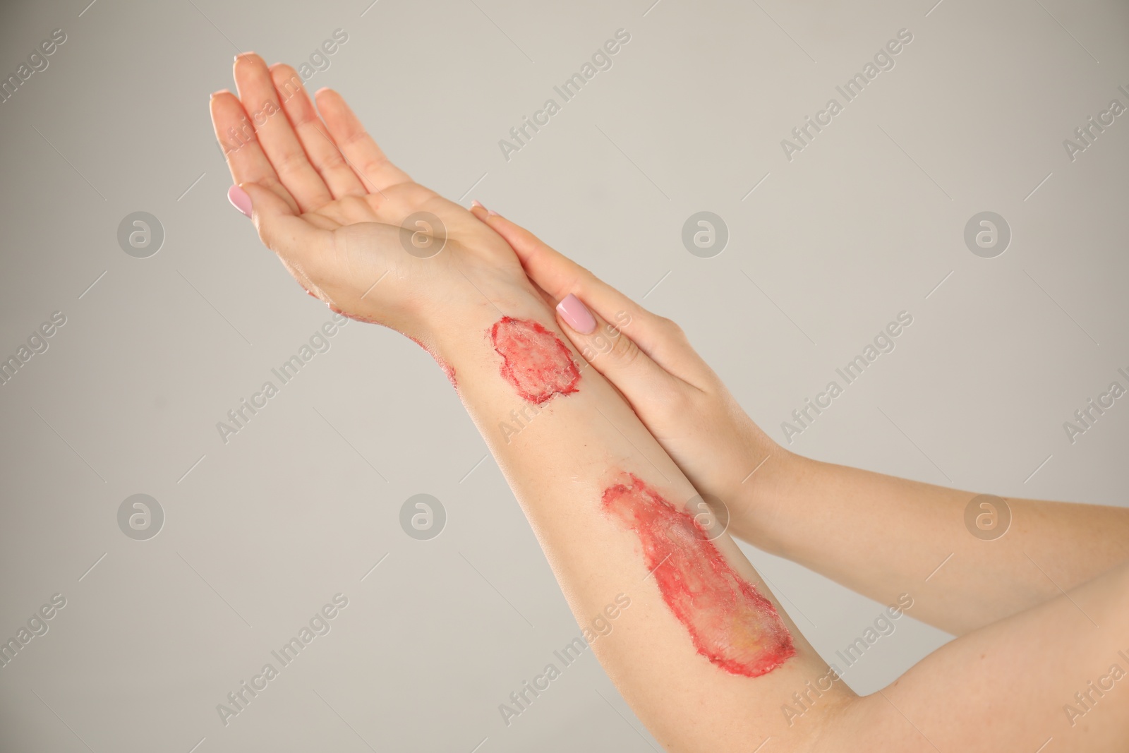 Photo of Woman with burned hand on light grey background, closeup
