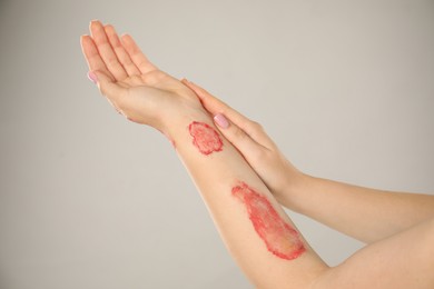 Photo of Woman with burned hand on light grey background, closeup