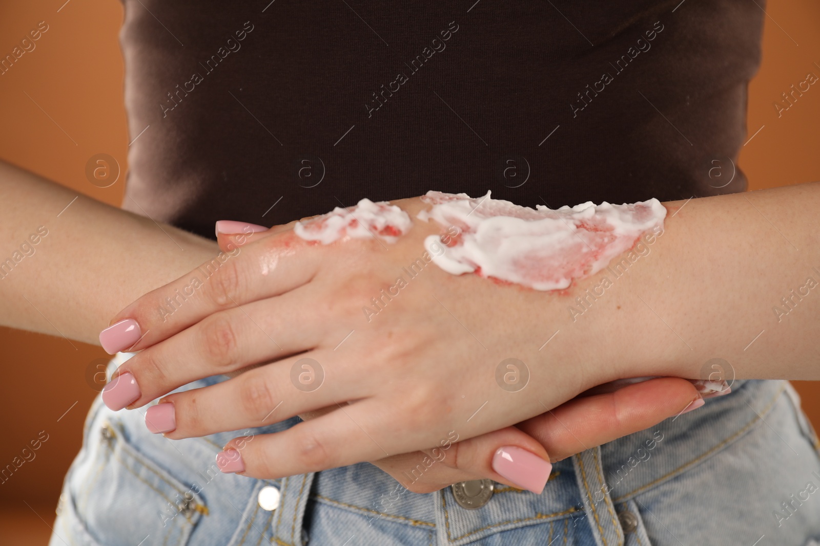 Woman applying healing cream onto burned hand on brown background, closeup Photo of Woman applying healing cream onto burned hand on brown background, closeup