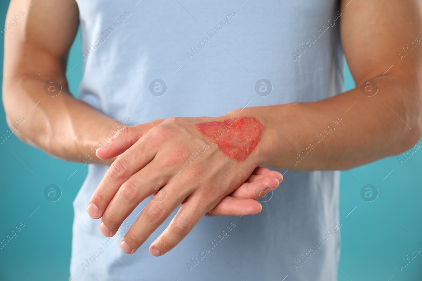 Man with burned hand on light blue background, closeup Photo of Man with burned hand on light blue background, closeup