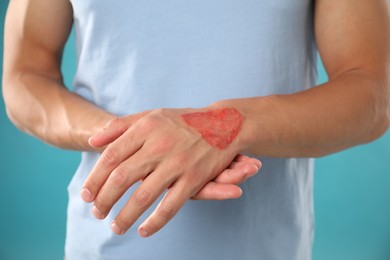 Photo of Man with burned hand on light blue background, closeup