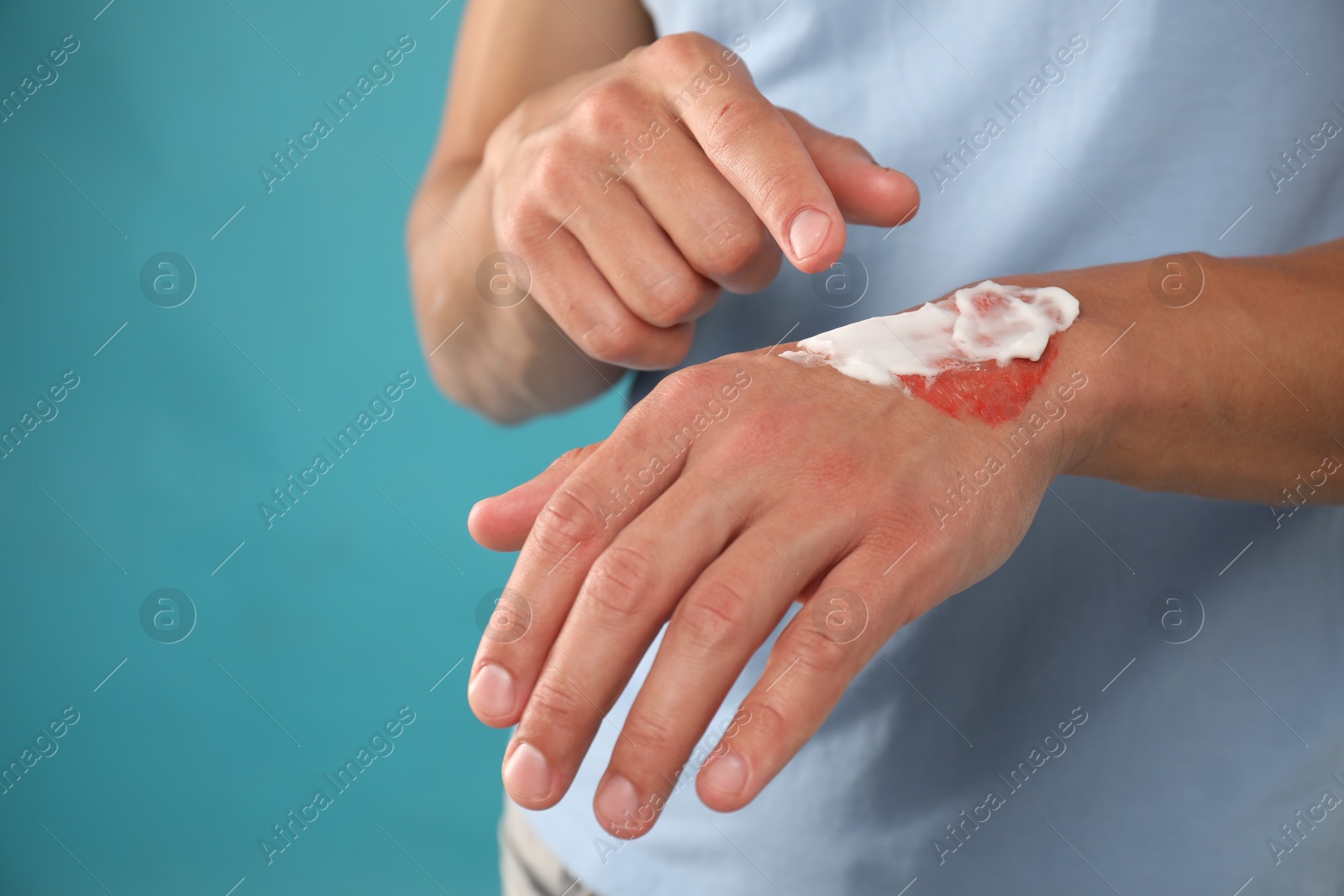 Man applying healing cream onto burned hand on light blue background, closeup Photo of Man applying healing cream onto burned hand on light blue background, closeup