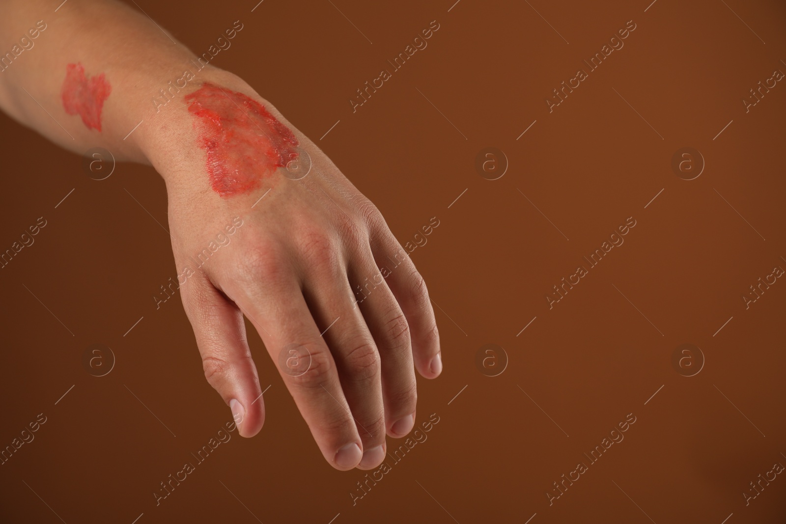 Man with burned hand on brown background, closeup. Space for text Photo of Man with burned hand on brown background, closeup. Space for text
