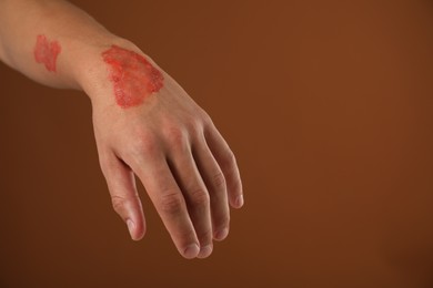 Photo of Man with burned hand on brown background, closeup. Space for text