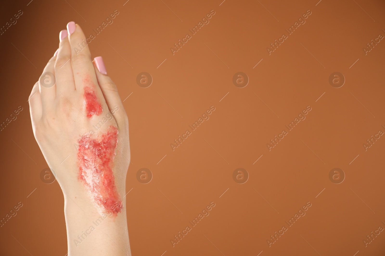 Photo of Woman with burned hand on brown background, closeup. Space for text
