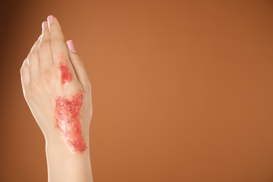 Photo of Woman with burned hand on brown background, closeup. Space for text