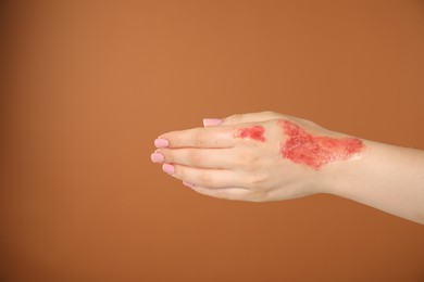 Photo of Woman with burned hand on brown background, closeup. Space for text