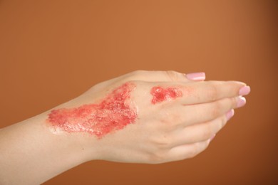 Photo of Woman with burned hand on brown background, closeup