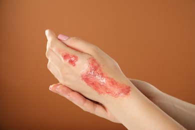 Photo of Woman with burned hand on brown background, closeup