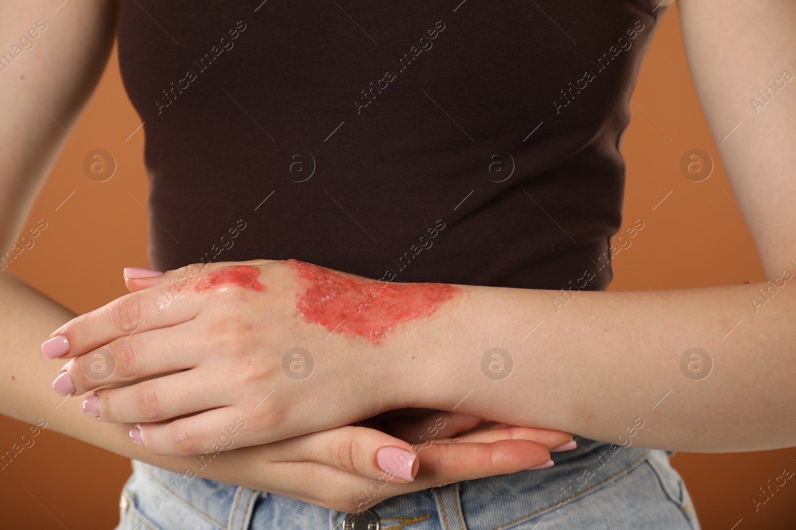 Woman with burned hand on brown background, closeup Photo of Woman with burned hand on brown background, closeup