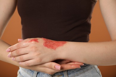 Photo of Woman with burned hand on brown background, closeup