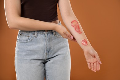 Photo of Woman with burned hand on brown background, closeup