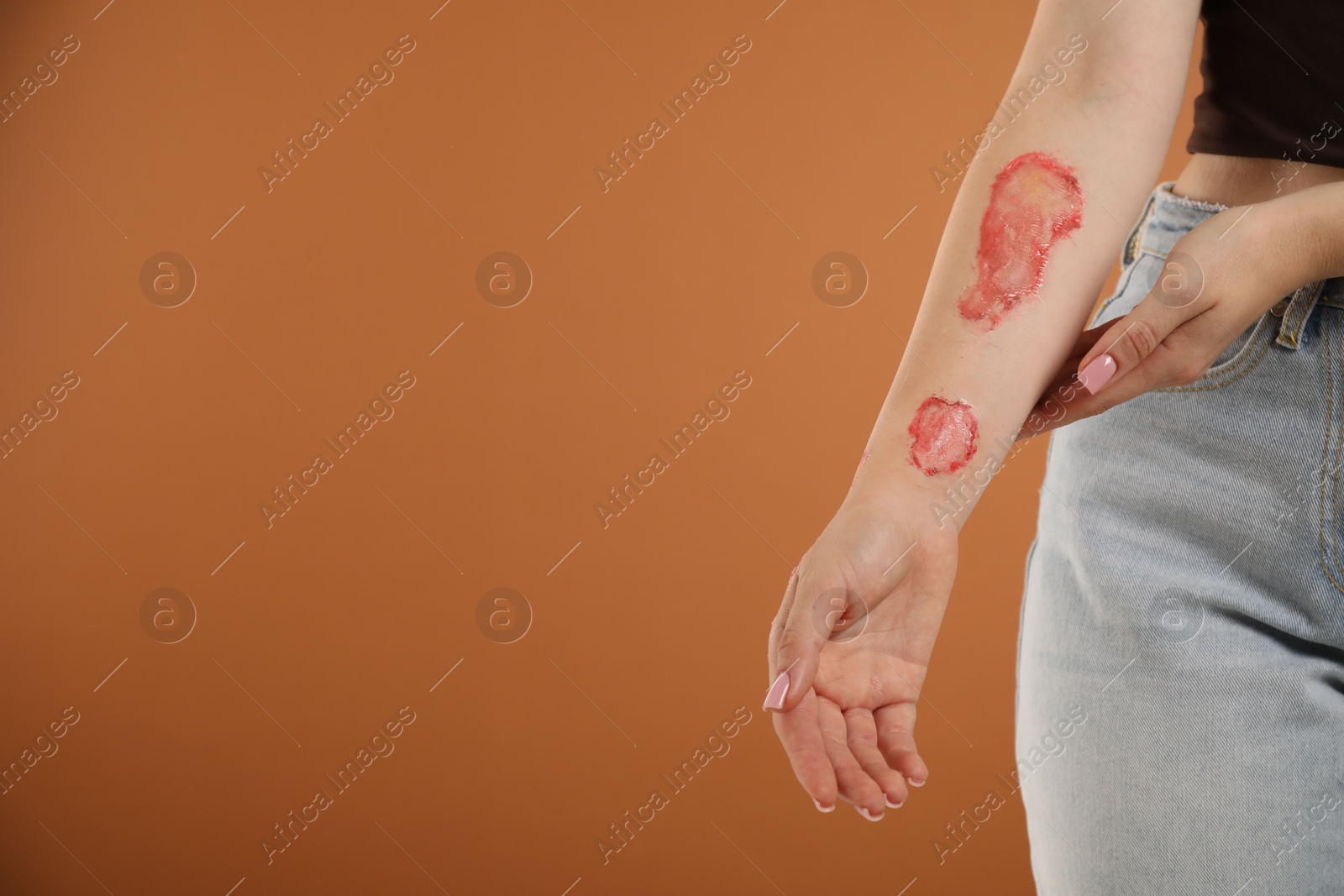 Photo of Woman with burned hand on brown background, closeup. Space for text