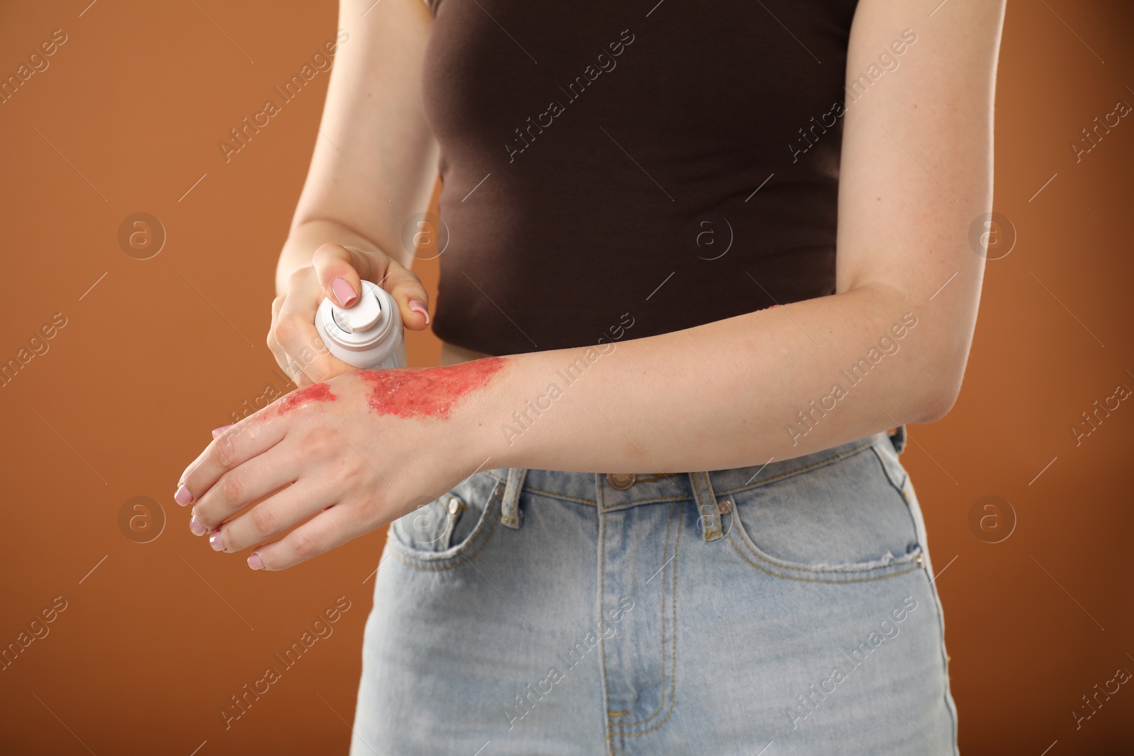 Woman applying healing cream onto burned hand on brown background, closeup Photo of Woman applying healing cream onto burned hand on brown background, closeup
